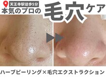アルムダアクア 天王寺店(Aleumda AQUA)の雰囲気（本気の肌質改善専門店★"REVIハーブピーリング""毛穴プロ"）