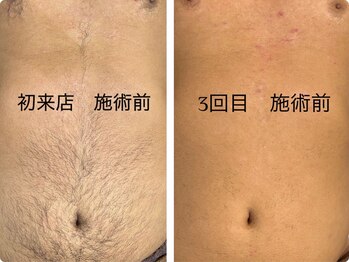 ワイスリー(Y3)/メンズ脱毛