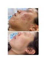 ニキビケア研究所 吉祥寺店/赤みの強い跡も改善！