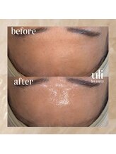 ウリ(uli beauty)/比較写真