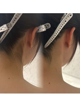 ラヴィン なんばスカイオ店(Lovin)/花嫁♪襟足＆背中　産毛ケア