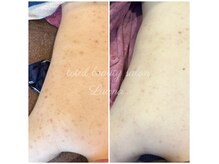 ルアナ 柏本店(LUANA)の雰囲気（滑らかなお背中に変化｜ハーブピーリング柏）