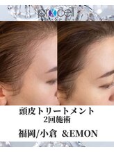 アンドエモン(&EMON)/【頭皮】プロセル効果