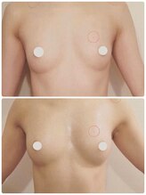 オリーブ 金沢(Olive)/バストアップ★育乳症例