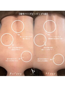 アピュルテ(A purete')/背中ハーブ Before→After