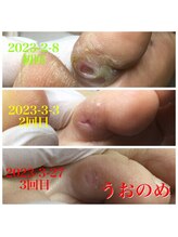 プラスキュア 用賀店(+CURE)/タコうおのめケア60分￥6600～