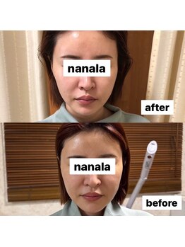 ナナラ(nanala)/ルビーセルリフトアップ体験