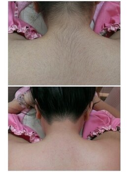 ルーク(RuCu)/背な毛もツルリン/ワックス脱毛