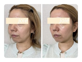 ジョワ 北堀江(joie)/小顔矯正/エラ、むくみ改善！