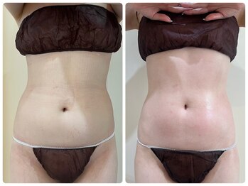 エイシスグロウ(asis glow.)/効果写真