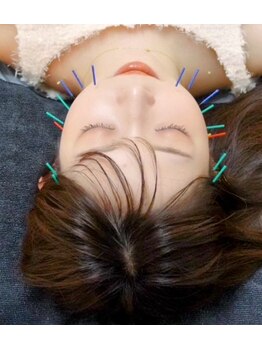 美麗鍼灸院/美容鍼♪