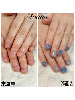 モアナ 池袋(MOANA)/人工爪深爪改善