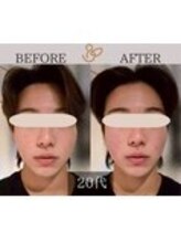 チョコバリ 錦糸町店(chocobari)/小顔×リフトアップ(美容鍼)20代