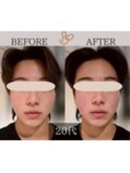 チョコバリ 錦糸町店(chocobari)/小顔×リフトアップ(美容鍼)20代