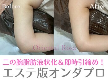 オリエンタルローザ 表参道(Oriental Rosa)/頑固脂肪を即時液状化で引き締め