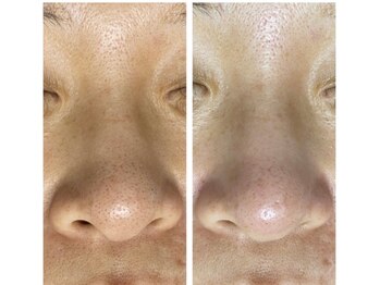 ファブ 青葉店/毛穴洗浄