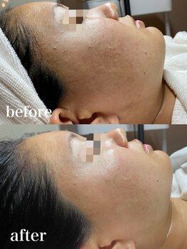 スパ ザ 睡(SPA The Sui)/白ニキビに効く乳酸ピーリング