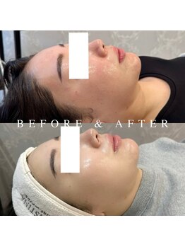 パリスヒロトン(PARIS HIROTON)/オプティル白玉 5回(20代)