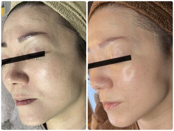 キレイ(KIREI)/before　＆　after