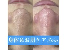 ソアン(Soin)/毛穴洗浄プレミアムコース