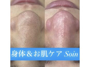 ソアン(Soin)/毛穴洗浄プレミアムコース