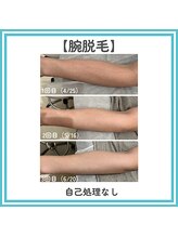 トッコ 那須塩原店(tocco)/腕脱毛