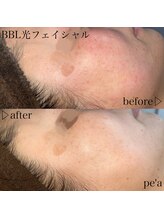 ペア(pe'a)/光フェイシャルbefore★after
