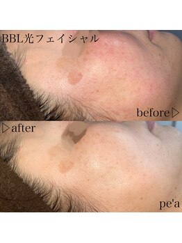 ペア(pe'a)/光フェイシャルbefore★after