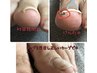 巻き爪ケア初回(親指一本)¥8800