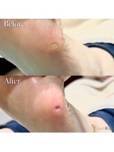 巻き爪補正店 柏店/タコ・魚の目ケア