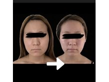 スリーメイ(3mey)/BTXサーマ×脂肪よう解