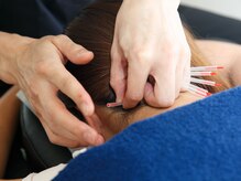 ハリハリ(HALIHALI)/首への鍼施術☆