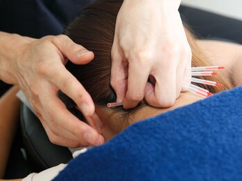 ハリハリ(HALIHALI)/首への鍼施術☆