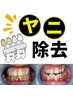 【喫煙者の方】セルフホワイトニング(歯磨き込) 初回お試し ¥2,750