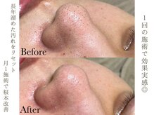 ツルツル毛穴にします★お得なセットメニューもご用意しています