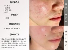 ルディラ 渋谷店/水光肌フェイシャル