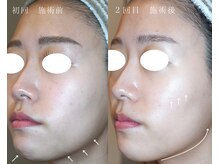 岩川治療院/ハイブリッドコース　２回施術