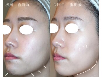 岩川治療院/ハイブリッドコース 2回施術