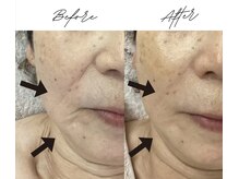 BBL光フェイシャルはたるみ・ほうれい線など年齢サイン改善に◎