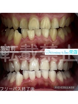 ホワイトニングサロン 名古屋 栄店/【ホワイトニング】