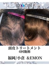 アンドエモン(&EMON)/【頭皮】プロセル効果