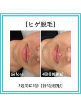 トッコ 那須塩原店(tocco)/ヒゲ脱毛