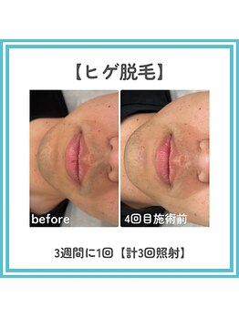 トッコ 那須塩原店(tocco)/ヒゲ脱毛