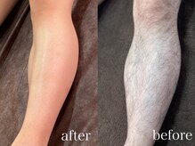 レオ(LEO)/【足脱毛】