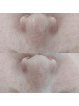 ヴェルシック(Belchic)/毛穴レス肌に!