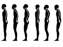 異常な姿勢は骨盤および脊椎と骨格の変位（歪み）が主な原因です