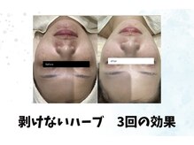 リンフェイス 浦安店(RINFACE)の雰囲気（【本気で肌荒れ改善】剥離なしハーブピーリング&ヒト乳歯幹細胞）