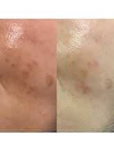 ロメリア(Roemeria)/お客様BeforAfter