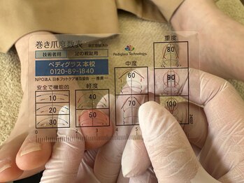 巻き爪ケア【STEP２】