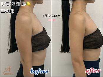 アモーラ(Amora)/レモンボトル二の腕